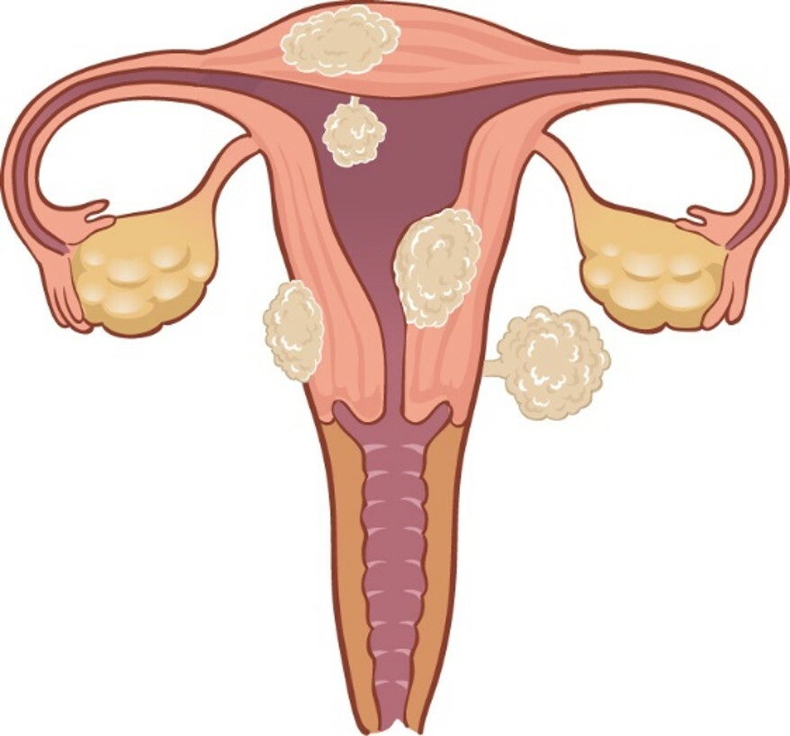 Fibroids